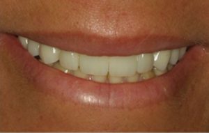 Real patient's smile after porcelain veneers are applied