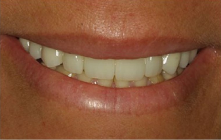 Porcelain vs Composite Veneers: Which Veneer Type Is Right For You?