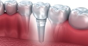 A placed dental implant