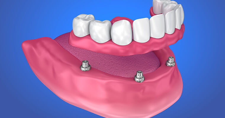 Denture Implants: A Complete Guide to the Procedure, Costs, and Benefits